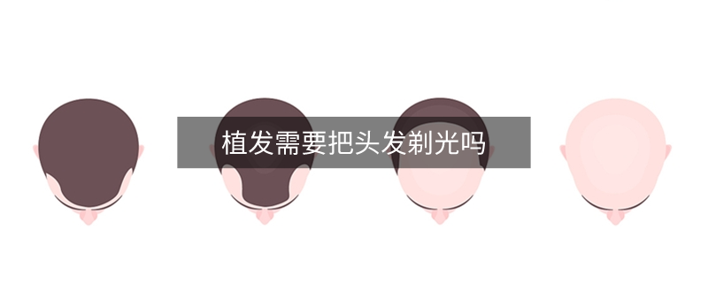 植发需要把头发剃光吗